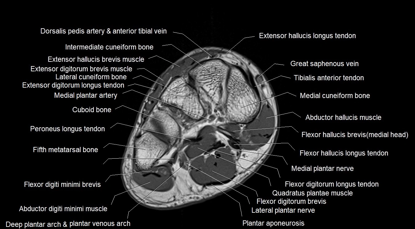 MRI 3T foot axial cross sectional anatomy image 9.webp